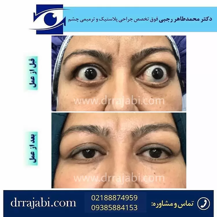 درمان قطعی تیروئید چشمی