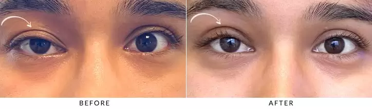جراحی پتوز پلک