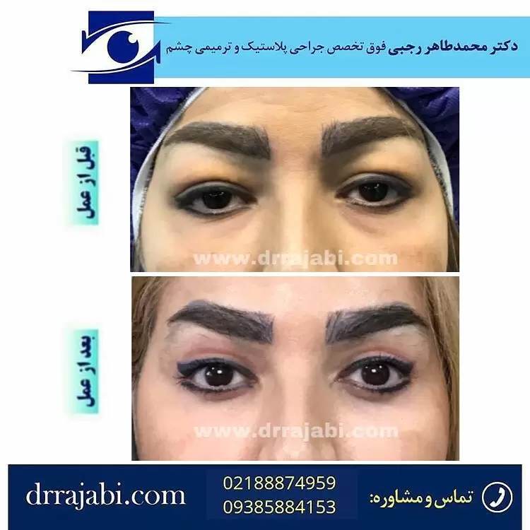 بلفاروپلاستی پلک بالا و پایین