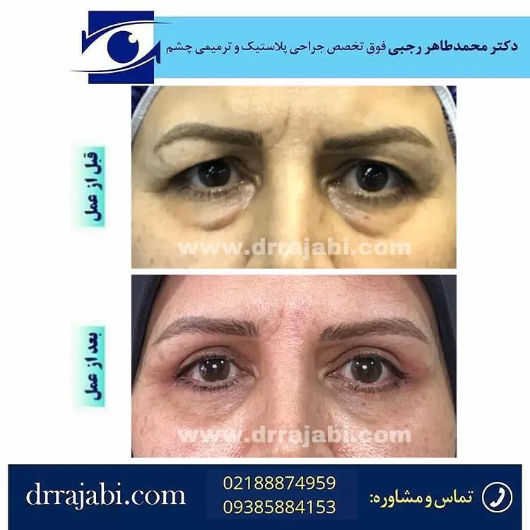 بلفاروپلاستی