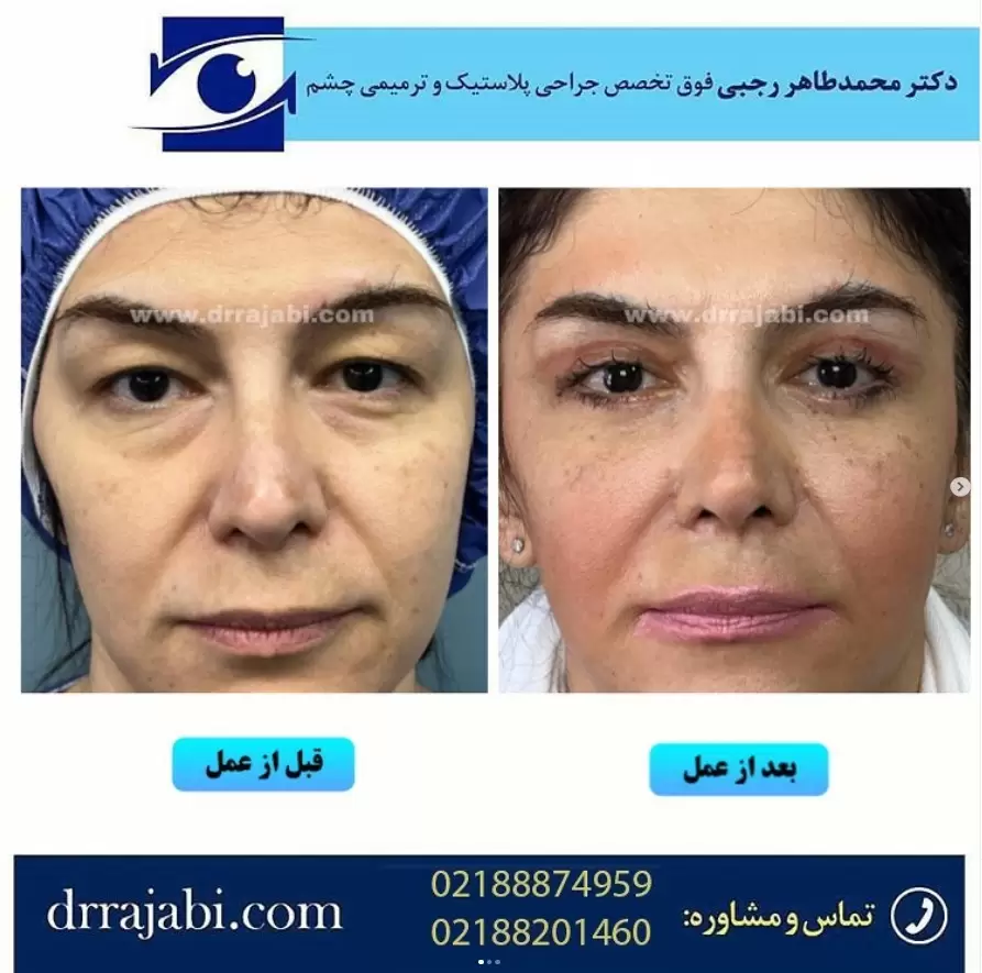 جراحی بلفاروپلاستی پلک شرقی