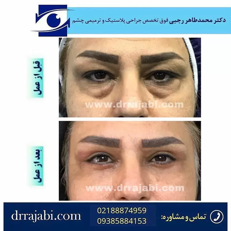 نتایج بلفاروپلاستی