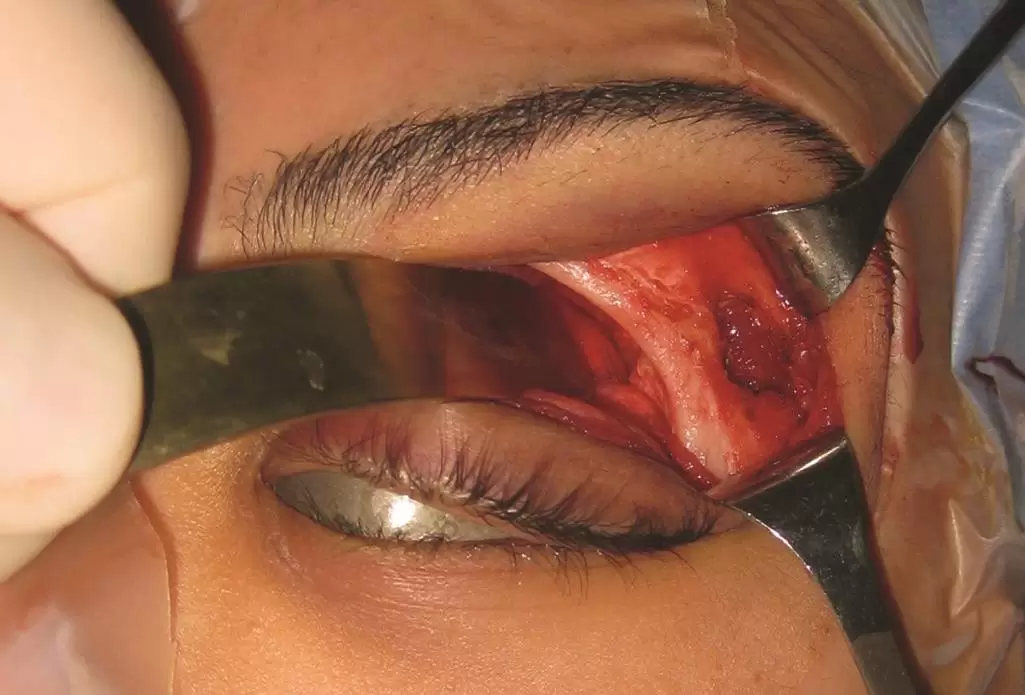 جراحی اوربیتوتومی