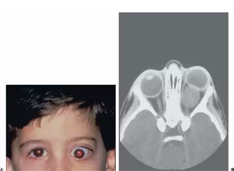 تومور عصب بینایی چشم