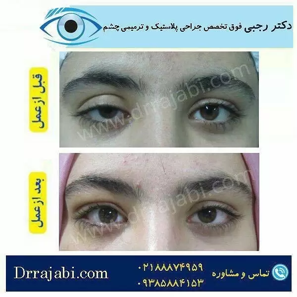 جراحی پتوز چشم