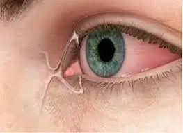 بسته&zwnj;شدن مجاری اشکی