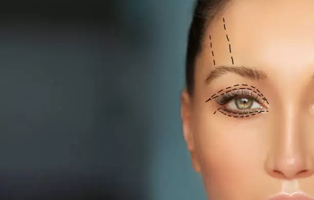 ورزش بعد از عمل بلفاروپلاستی