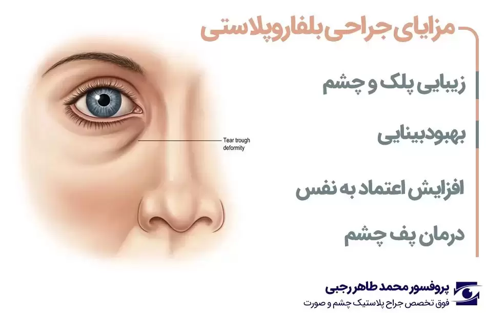 مزایای بلفاروپلاستی