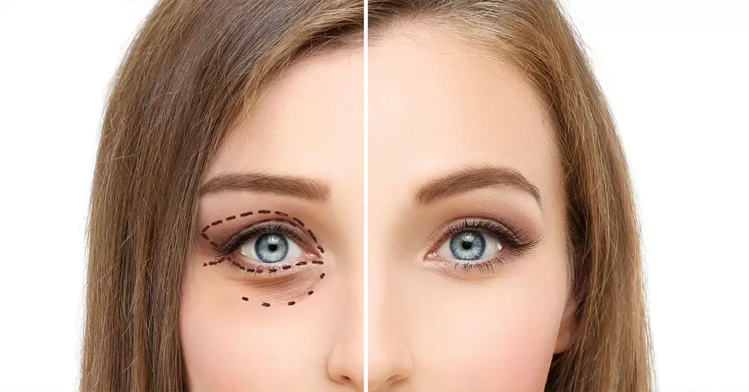 مراقبت&zwnj;های بعد از عمل چشم گربه&zwnj;ای