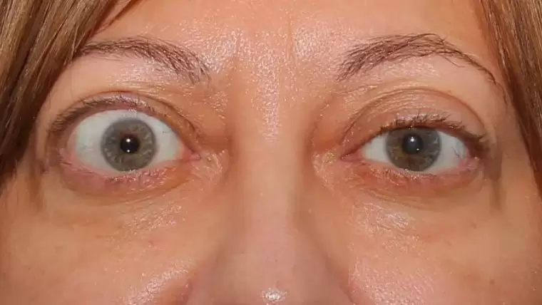 اگزوفتالموس