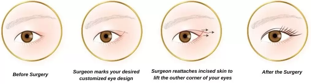 درمان عفونت و التهاب بعد از عمل کانتوپلاستی