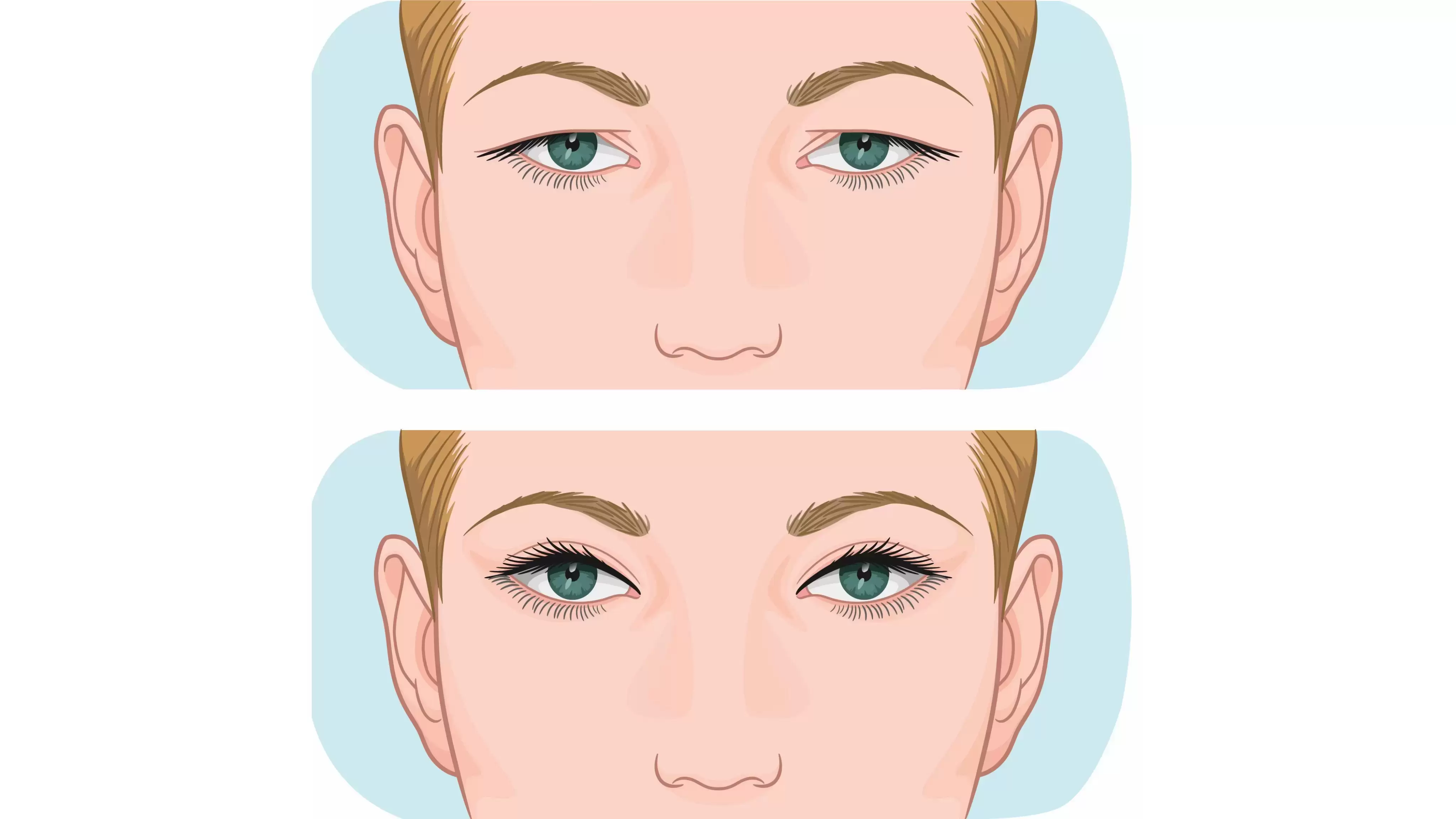 جرایح پلک برگشت پذیر است